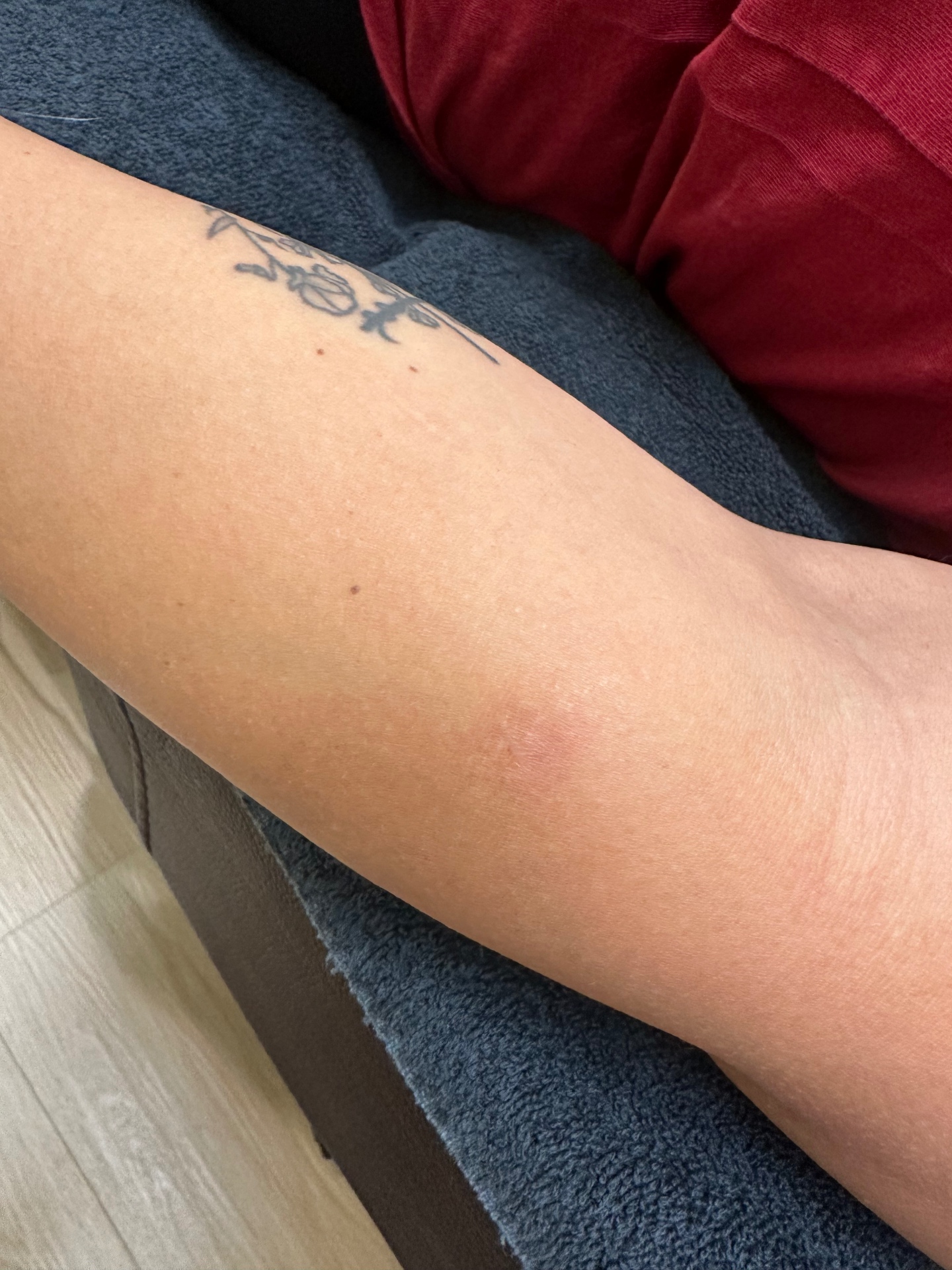 Forearm dark scar healed 6 weeks after one session