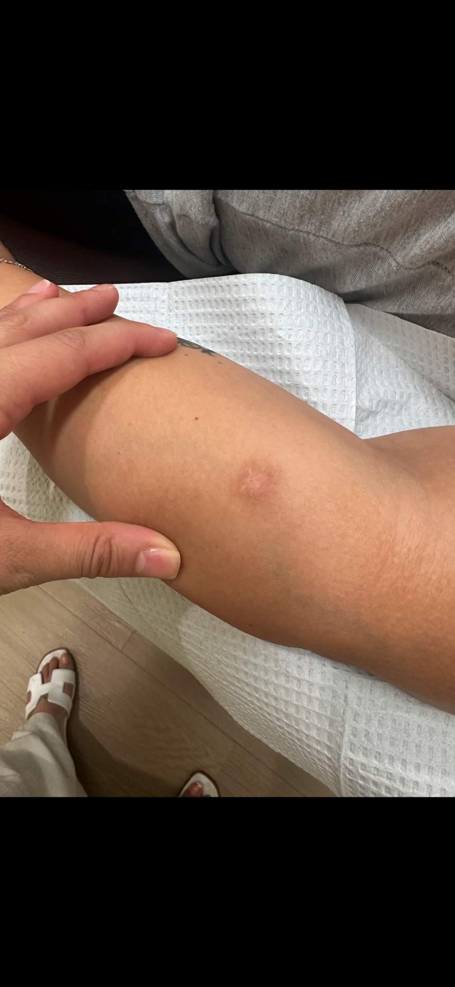 Dark scar on forearm immediately after first session