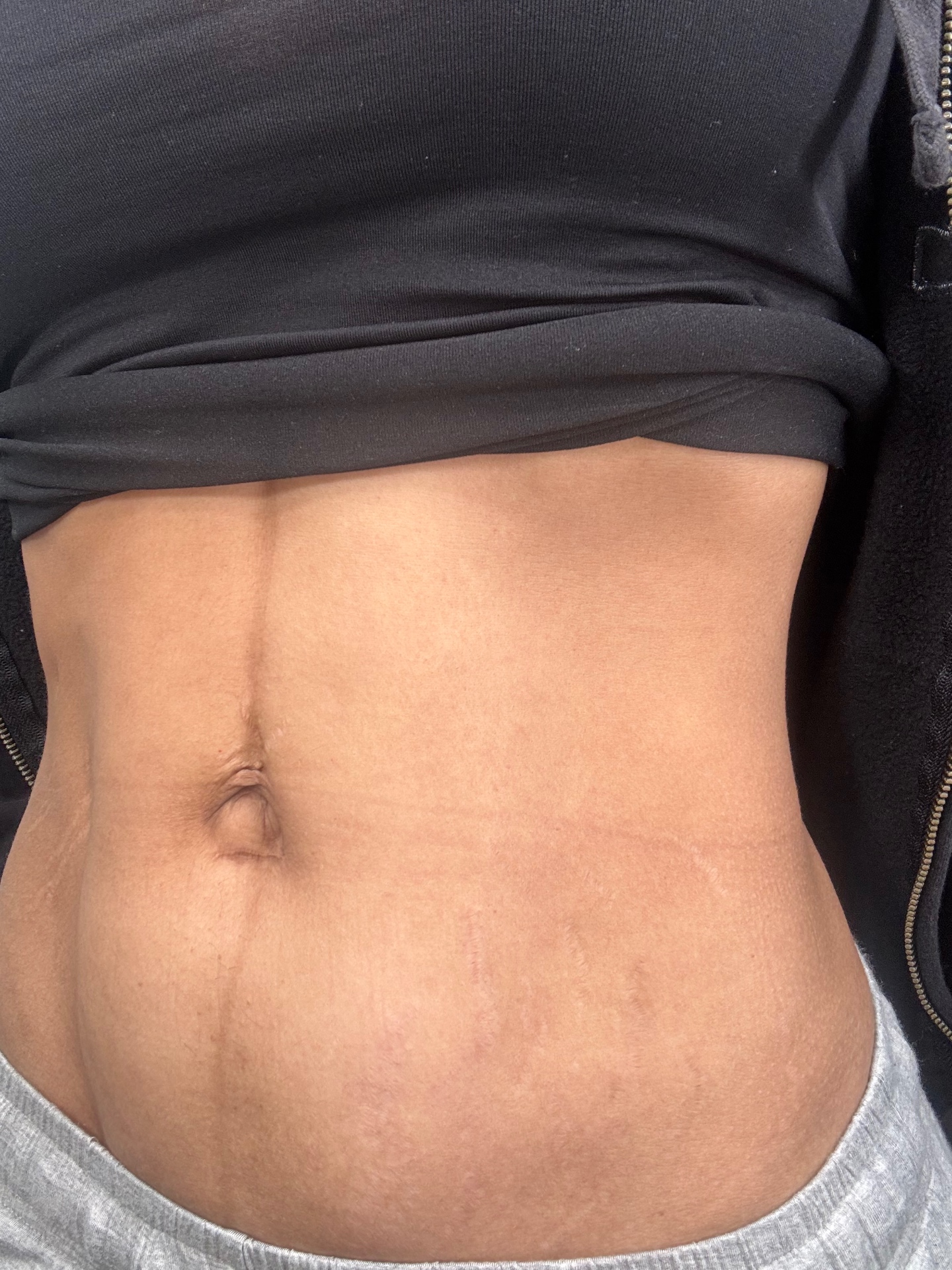 Abdomen stretch marks softened and blended after camouflage treatment