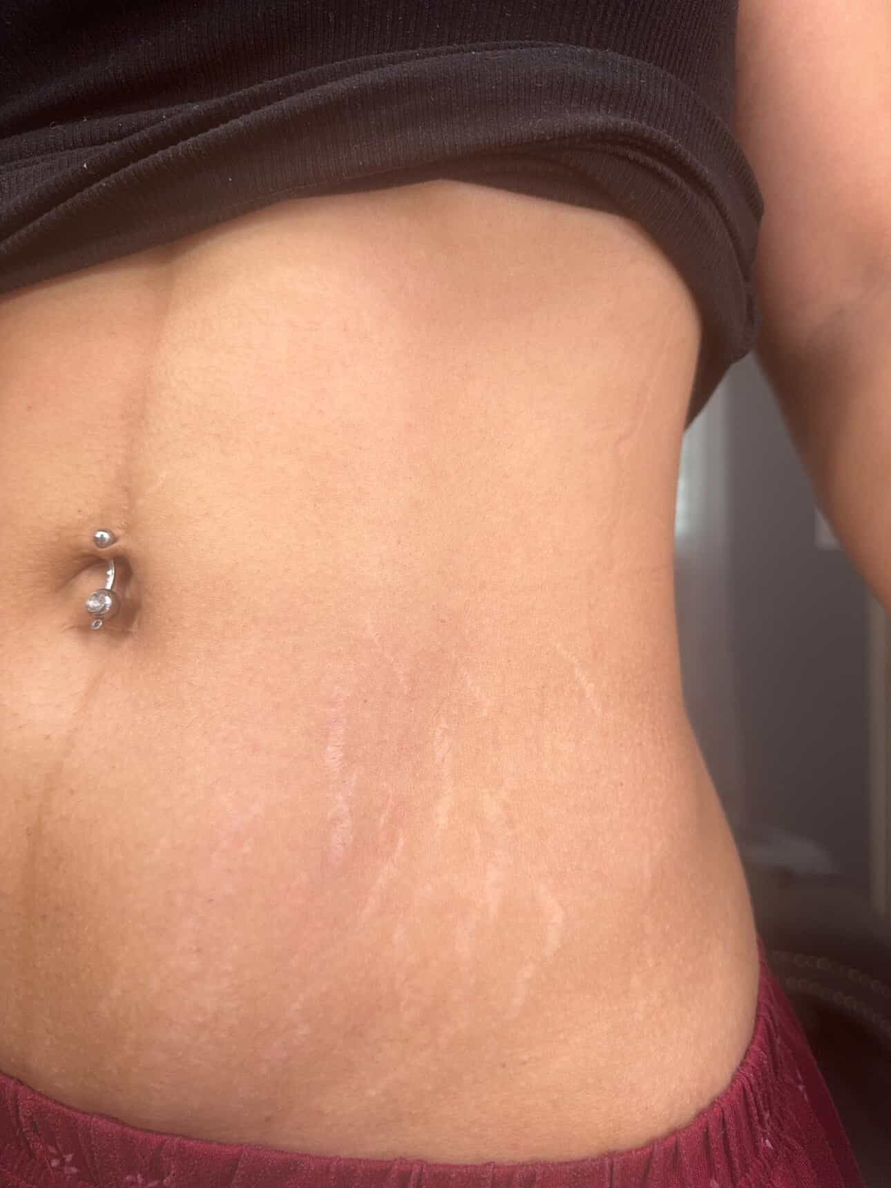 Abdomen with mature stretch marks before camouflage treatment